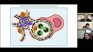 ACTUALIZACIÓN EN EL DIAGNÓSTICO Y TRATAMIENTO DE LA GLOMERULONEFRITIS MEMBRANOPROLIFERATIVA 7 [upl. by Frech958]