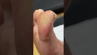 Big Toe Callus Removal Expert Treatment by Australian Podiatrist [upl. by Down492]