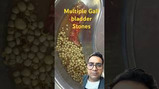 Multiple Gall bladder Stones 7428617074 [upl. by Photima]