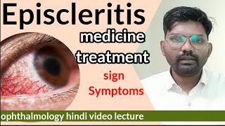 Episcleritis treatment  Episcleritis disease in eye  sclera anatomy  Episcleritis  optometry [upl. by Gyasi]