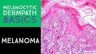 Melanocytic Dermpath Basics Melanoma [upl. by Darken]