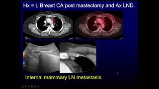 PET CT for breast cancer [upl. by Dannel468]