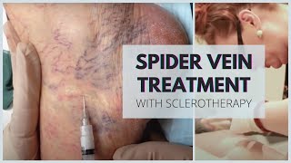 Sclerotherapy  Spider Veins Treatment at Vein Health Vein Clinic [upl. by Gad444]