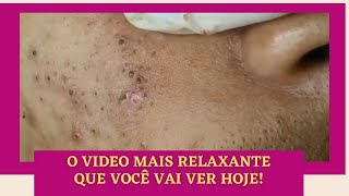 🌹Extração de Cravo Severo  Video Relaxante e Satisfatorio [upl. by Eseilenna]