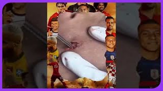 Satisfying Blackhead Removal Popping Pimples and Blackheads on Skin  2024 [upl. by Rfinnej]