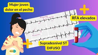 Caso clínico TIPICO de PERICARDITIS AGUDA  Dx diferencial de SCACEST [upl. by Alysia855]