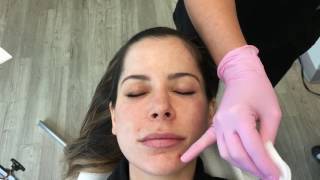 Demonstration of Chemical Peel [upl. by Malda]