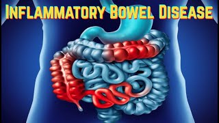 Inflammatory Bowel Disease updated 2021  CRASH Medical Review Series [upl. by Stacee]