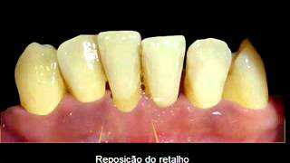 RETALHO APICAL [upl. by Villada]