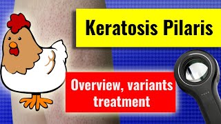 Keratosis pilaris overview associations variants management [upl. by Noraa577]