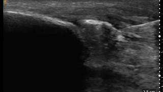 Ultrasound Guided PRP Injection into Patellar Tendon [upl. by Edyaw]