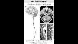 von HippelLindau disease dominant tumor suppressor gene mutation [upl. by Brufsky154]