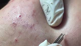 BLACKHEAD  ACNE TREATMENT MAI NGOC [upl. by Devona]