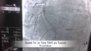 La 1ère TAVI en Tunisie [upl. by Arias595]