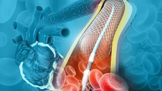 How Angioplasty Procedure Is Performed  Balloon Angioplasty And Coronary artery stent Procedure [upl. by Mcilroy]