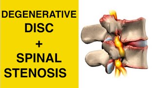 Sciatica Exercises  Stretches for Spinal Stenosis amp Degenerative Disc Disease Treatment [upl. by Odinevneib]