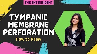 Tympanic Membrane Perforations  How to Draw [upl. by Anaic]