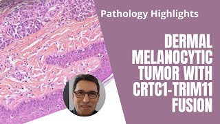 Pathology highlights  Dermal melanocytic tumor CRTC1 [upl. by Gensmer]