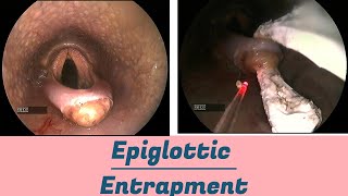 Epiglottic Entrapment [upl. by Marcoux]