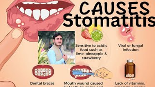 Stomatitis Chapter1 Disease1 AHN 3rd semester kmu slides in pashto drnajeebnote drnajeeb kmupdat [upl. by Nywloc]