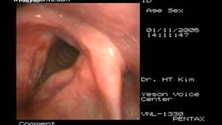 Laryngoplasty of sulcus vocalis [upl. by Zeba]