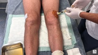 Knee effusion and arthrocentesis Swollen knee English version [upl. by Anyrak983]