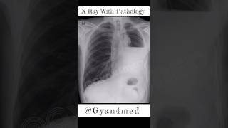 Chest XRay Normal vs Abnormal view [upl. by Daren]