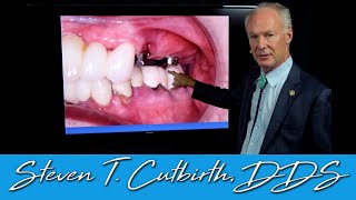 Supra Erupted Teeth  Dental Minute with Steven T Cutbirth DDS [upl. by Woodford]