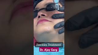 Freckles treatment instead glowing facial skinshine likeandsubscribe [upl. by Nwahsaj]