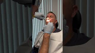 Nasal splint removal one week after Septoplasty [upl. by Janyte]