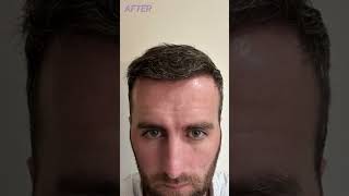 Hair Transplant Turkey Results  Before and After  Longevita [upl. by Maisel]