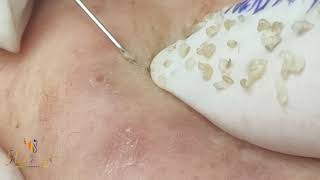 SPA HIEN NGUYEN ACNE TREATMENT  REMOVE PIMPLES HIDDEN [upl. by Fiorenza]