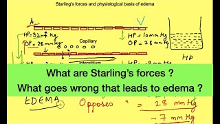 Starling forces hydrostatic pressure vs oncotic pressure  Pathophysiology of Edema [upl. by Ahsiram]