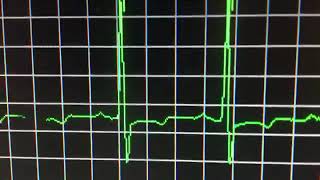 ECG continuo de 12 derivaciones en campesino con Angina de Pecho [upl. by Quiteris]