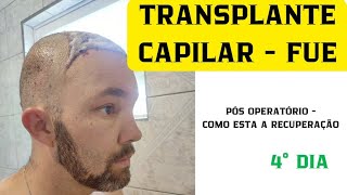 TRANSPLANTE CAPILAR  TÉCNICA FUE 4° DIA PÓS OPERATÓRIO [upl. by Min667]