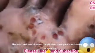 💥💥 JIGGERS HAVE YOU EVER HEARD OR SEEN THIS big blackheads ingrown hairs pimples cystic acnes [upl. by Mcclees]