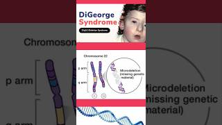 Digeorge syndrome  Microdeletion  Genetic disorder  ytshorts syndrome geneticdisorder [upl. by Antonina]