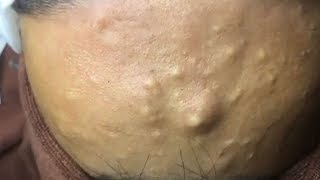 How to Remove Blackheads And Whiteheads On Face Easy ✦ Acne Treatment ✦ [upl. by Edlihtam]