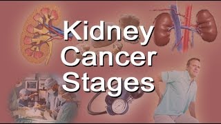 Kidney Cancer Stages [upl. by Margret]