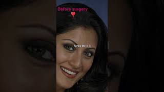 Rimi Sen before and after surgery [upl. by Ahsienaj]