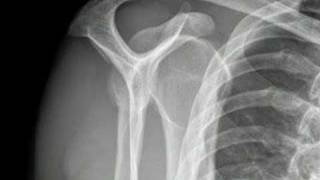 Dislocation Reduct Shoulder sample  proceduresconsultcom [upl. by Anidal761]