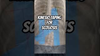 Kinesio Taping For Scoliosis ✅ poorposture scoliosis kinesiotaping physiofit physiotherapy [upl. by Herman830]