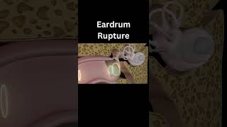 Ruptured Eardrum  3D Animation 👂 [upl. by Russell966]