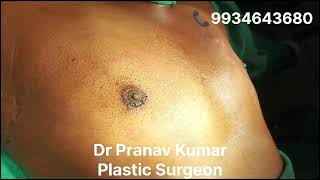 GYNECOMASTIA Grade 2 Immediate Postop ontable resultsDr Pranav Kumar Patna [upl. by Irihs911]