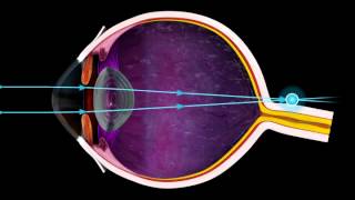 Short Sighted and Long Sighted  3D Medical Animation of the Eye  ABP © [upl. by Cristen837]