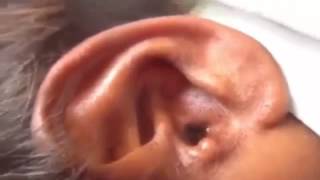 Ear botfly Botfly extraction human YouTube [upl. by Ivanah425]