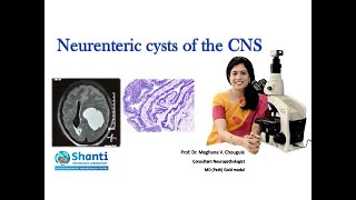 Neurenteric cysts of the CNS [upl. by Charyl]