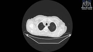 SCANNER THORACIQUE Épanchement pleural gauche responsable d’un collapsus passif du LIG [upl. by Noval]