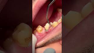 Removing retraction cord after tooth RCT amp composite restoration [upl. by Calmas900]