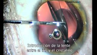 Lente intraocular para el tratamiento de la miopia hipermetropia y astigmatismo [upl. by Browning]